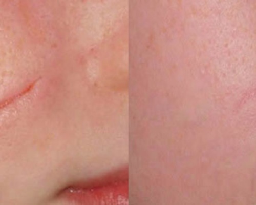 Akademia Urody Ewa Leszczyńska - Laser frakcyjny - lifting i regeneracja skóry