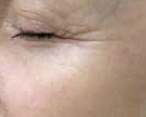 Akademia Urody Ewa Leszczyńska - Laser frakcyjny - lifting i regeneracja skóry