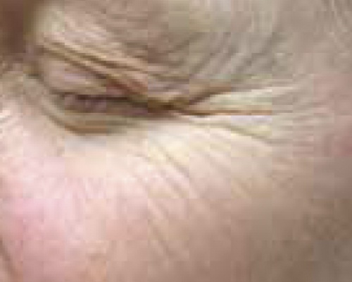 Akademia Urody Ewa Leszczyńska - Laser frakcyjny - lifting i regeneracja skóry