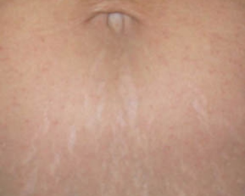 Akademia Urody Ewa Leszczyńska - Laser frakcyjny - lifting i regeneracja skóry