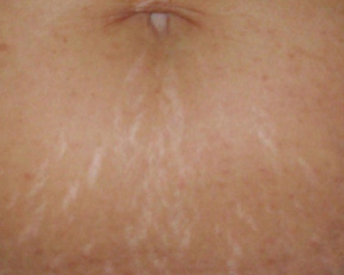 Akademia Urody Ewa Leszczyńska - Laser frakcyjny - lifting i regeneracja skóry