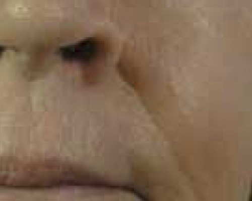 Akademia Urody Ewa Leszczyńska - Laser frakcyjny - lifting i regeneracja skóry