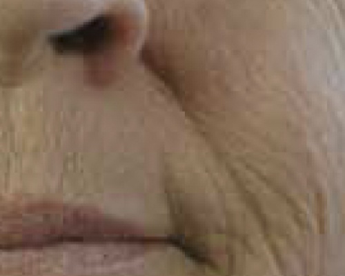 Akademia Urody Ewa Leszczyńska - Laser frakcyjny - lifting i regeneracja skóry