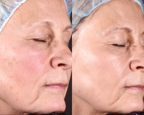 Akademia Urody Ewa Leszczyńska - Laser frakcyjny - lifting i regeneracja skóry