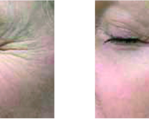 Akademia Urody Ewa Leszczyńska - Laser frakcyjny - lifting i regeneracja skóry