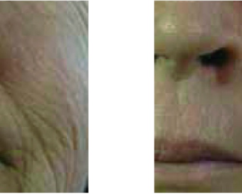 Akademia Urody Ewa Leszczyńska - Laser frakcyjny - lifting i regeneracja skóry