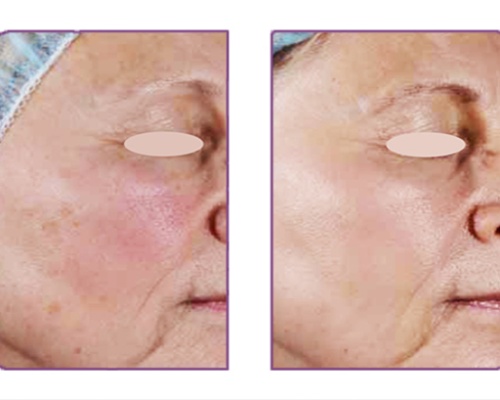 Akademia Urody Ewa Leszczyńska - Laser frakcyjny - lifting i regeneracja skóry