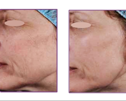 Akademia Urody Ewa Leszczyńska - Laser frakcyjny - lifting i regeneracja skóry