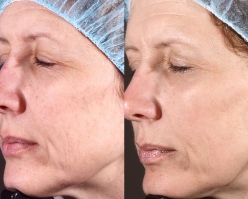 Akademia Urody Ewa Leszczyńska - Laser frakcyjny - lifting i regeneracja skóry