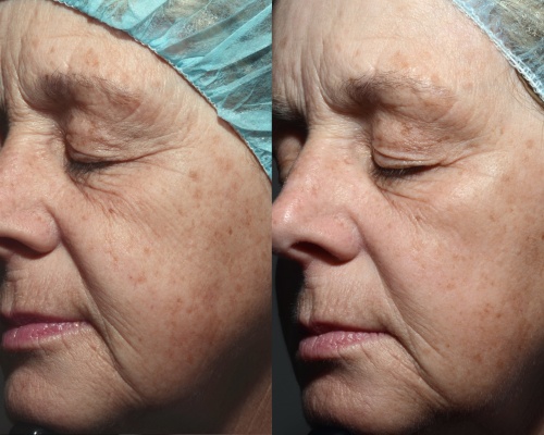 Akademia Urody Ewa Leszczyńska - Laser frakcyjny - lifting i regeneracja skóry