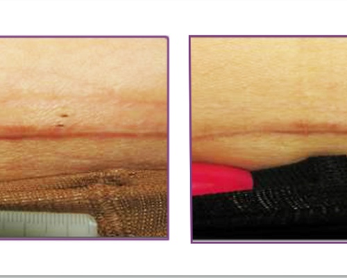 Akademia Urody Ewa Leszczyńska - Laser frakcyjny - lifting i regeneracja skóry