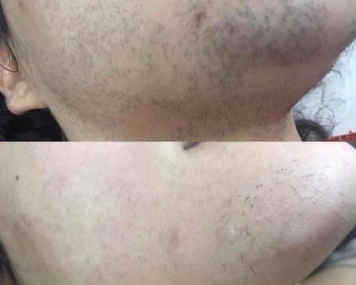 Konsultacja przed depilacją laserową brody u kobiety – Akademia Urody Ursynów