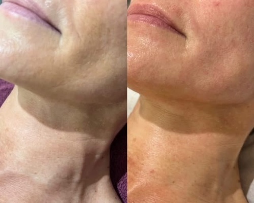 Terapię szyi dobieram do rodzaju problemu — może obejmować laser frakcyjny, IPL lub mezoterapię.